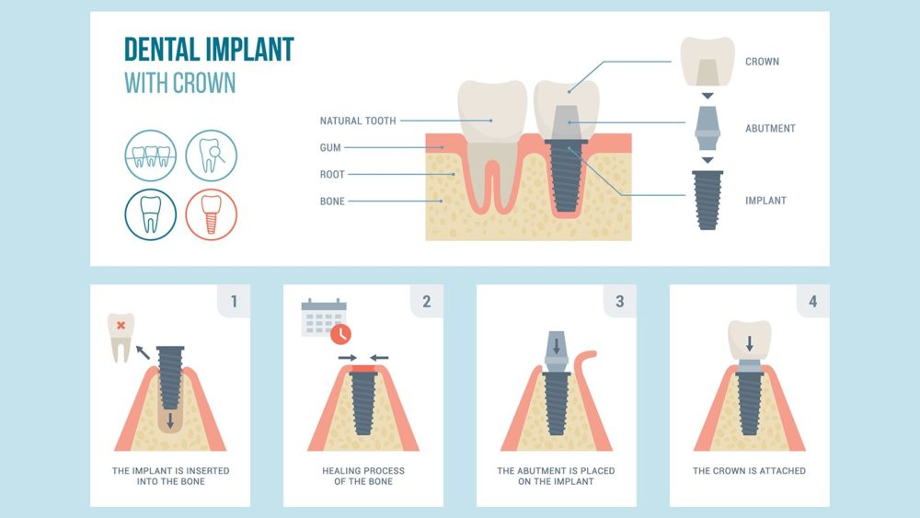 Dental implant procedure step including attaching a crown