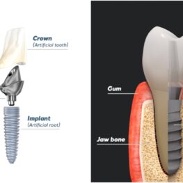 Diagram of the parts of a dental implant and where it sits in the mouth