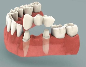 Diagram showing how a dental bridge fills a missing tooth gap