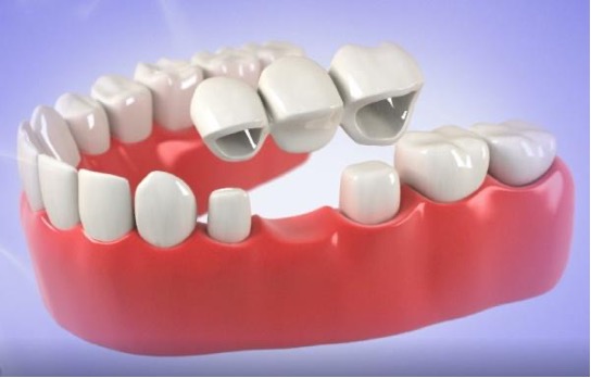 A sideview of a fixed dental bridge in the mouth