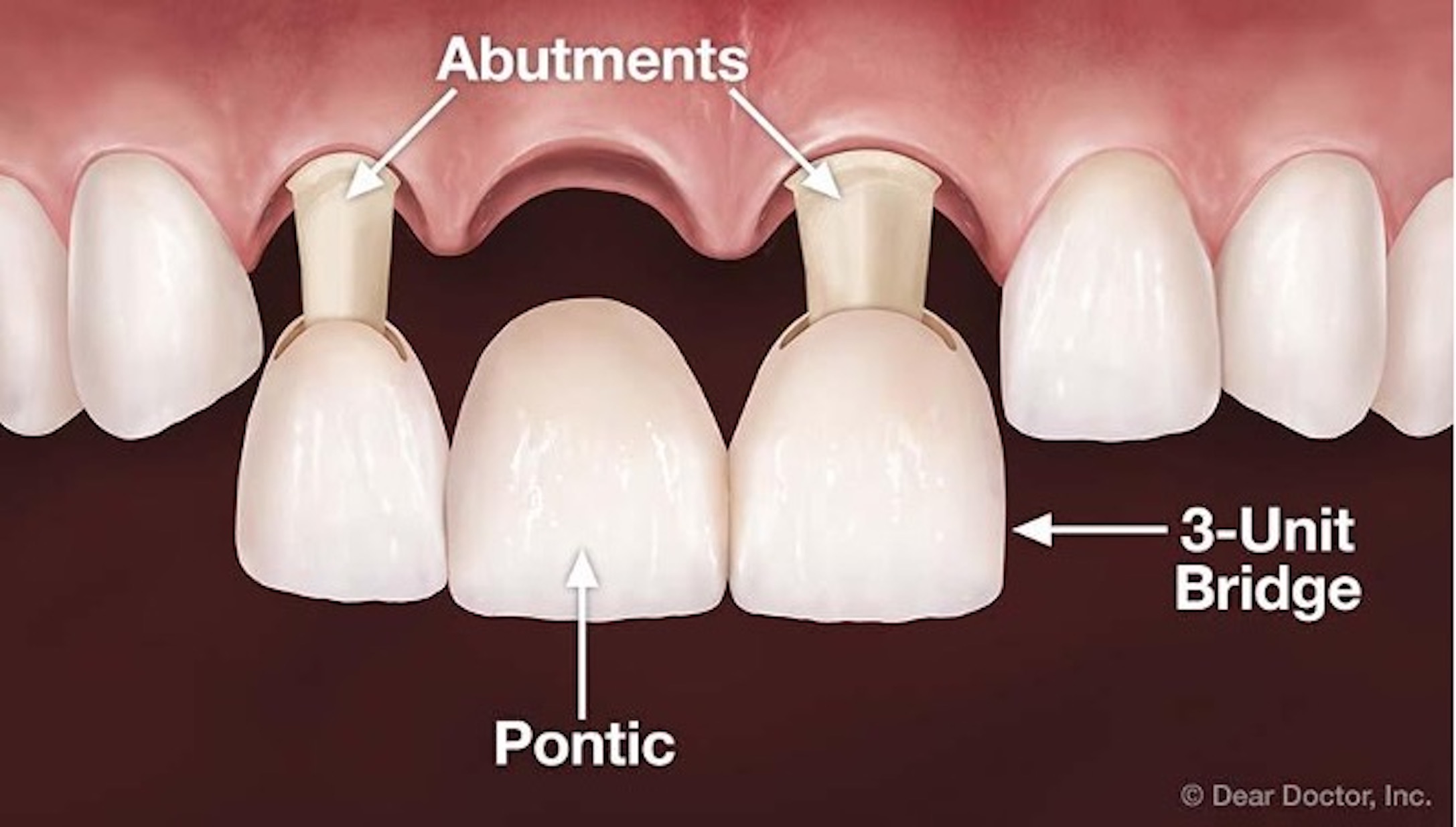 What Is A Fixed Dental Bridge The Kensington Dentist