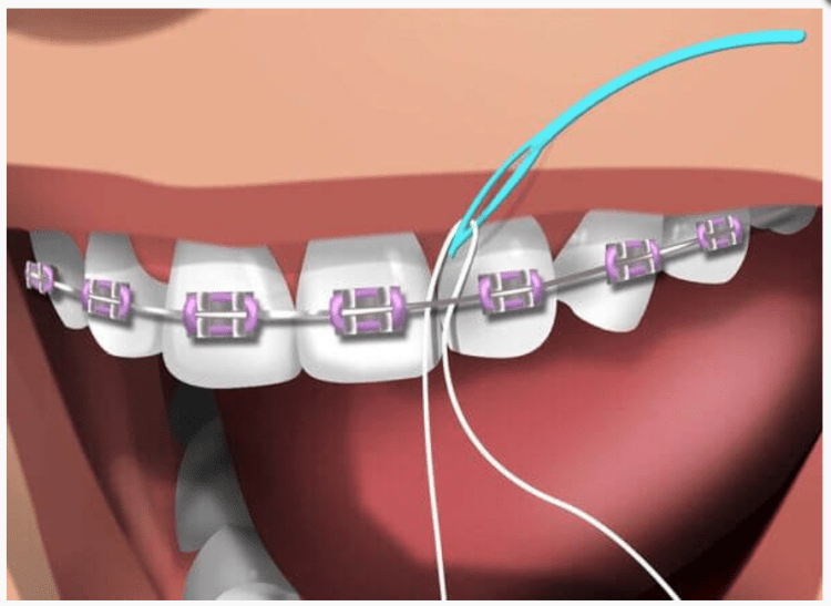 String Floss Types Types of Floss - The Kensington Dentist